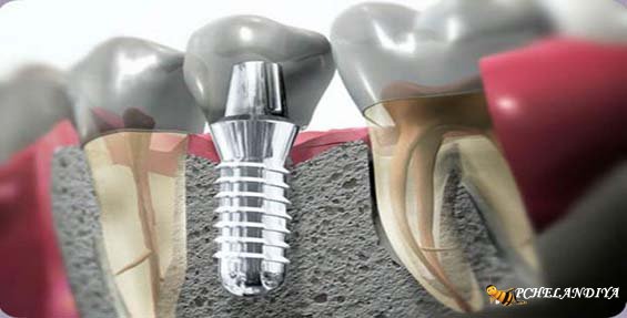 Имплантация зубов за и против: отзывы, под ключ, противопоказания