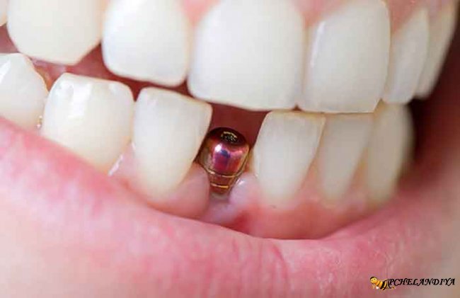 Сколько стоит поставить зубной протез на имплантах